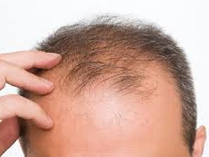 hair-loss-vitamin